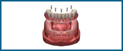 fixed-implant-denture