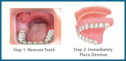 immediate-dentures