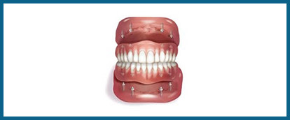 implant-snapon-denture