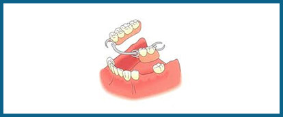removable-partial-denture