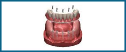 fixed-hybrid-denture