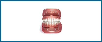 implant-supported-denture