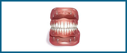 removable-implant-denture