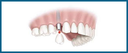 single-tooth-implant